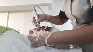 Crystal Microdermabrasion